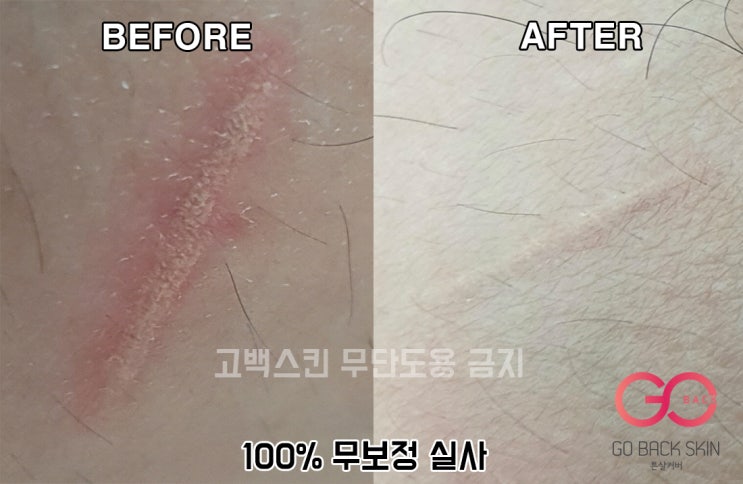  [고백스킨] 튼살타투 튼살커버 살색잉크 튼살 타투 테스트 관련 안내문