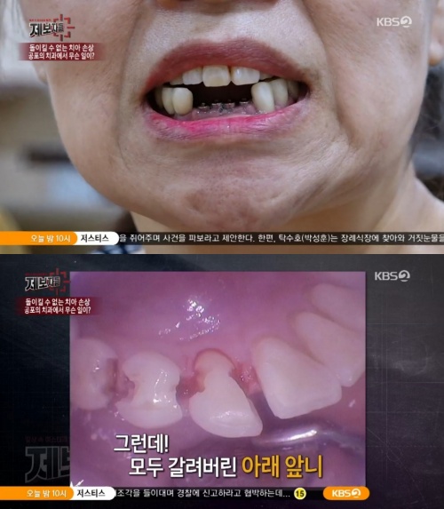 '제보자들’ 과잉진료 치과, 피해자 충격호소 “마취 후 치아 10개 갈아버려” '제보자들’ 과잉진료 치과, 피해자 충격호소 “마취 후 치아 10개 갈아버려”