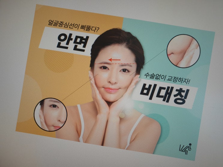  안면비대칭교정후기 3D모르페우스검사 해결하고 자신감 찾을래