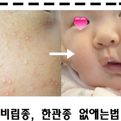 눈밑 한관종 신생아 비립종 원인 + 신생아 좁쌀여드름 완치 나코크림 추천