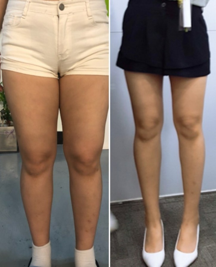  하체비만 다이어트 필요해? 빨리 읽는 게 좋아!  -12kg 