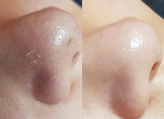  코에 블랙헤드를 코팩이나 면봉 셀프케어 하시기전에 