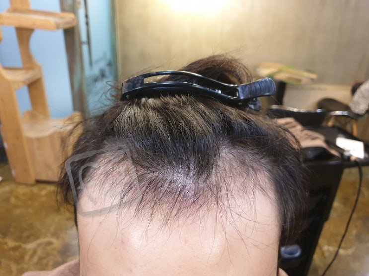 마포구 홍대 남자 앞머리 탈모 갈라짐 머리숱 헤어 증모 테이프 붙임머리