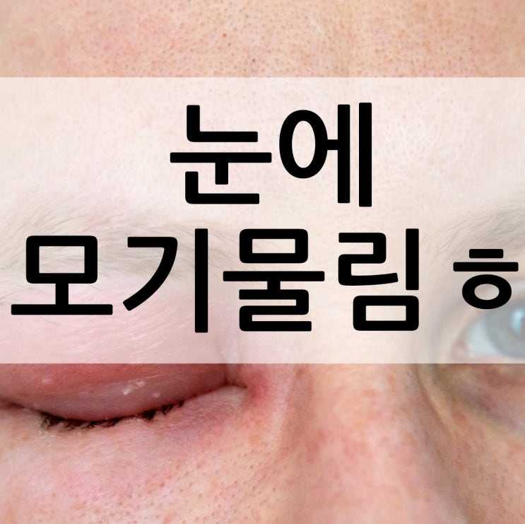  눈에 모기물렸을때 대처법