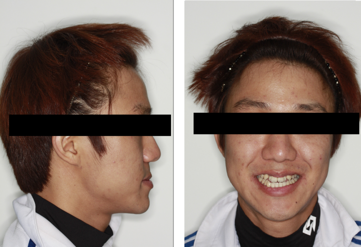  앞니 반대교합 주걱턱 교정