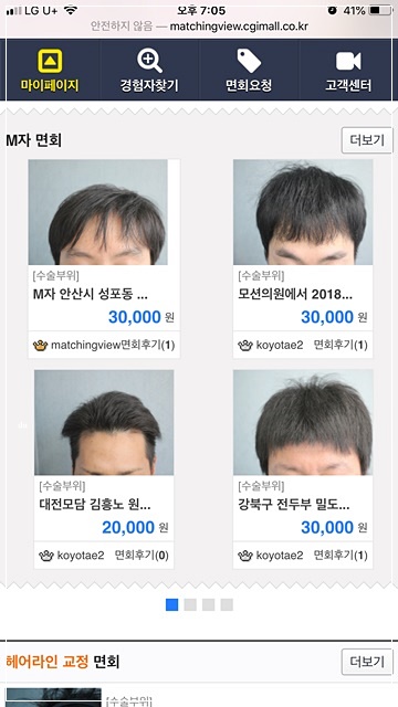  모발이식 면회 연세모벨르의원 모발이식 실제로 경험한 분에게 후기를 들어보세요