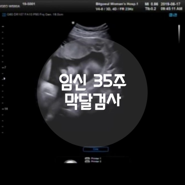  [출산준비] 임신9개월, 임신후기, 임신35주, 막달검사, 백일해주사