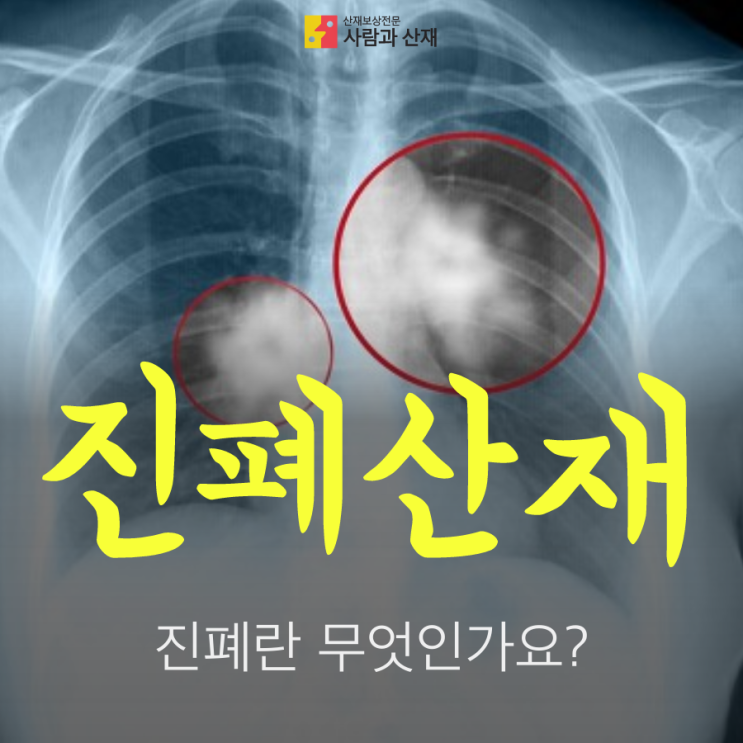  진폐도 산재신청 가능하다던데, 진폐란 무엇인가요?