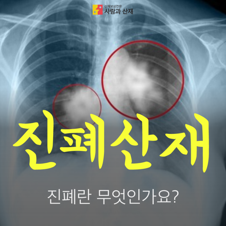 진폐도 산재신청 가능하다던데, 진폐란 무엇인가요?