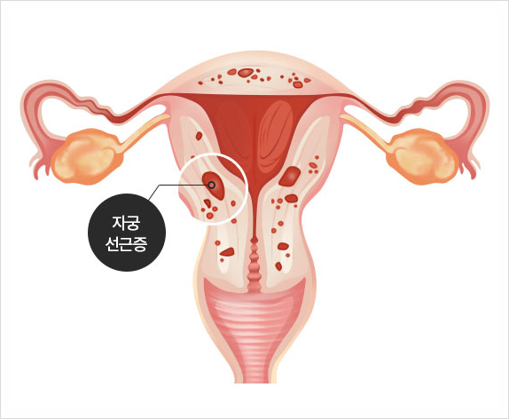  자궁선근증수술 잘하는 곳, 수술 권유하는 곳은 피하세요.