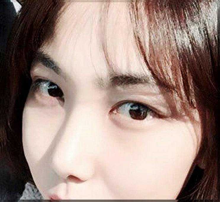 압구정눈앞트임 몽고주름 제거 효과는?
