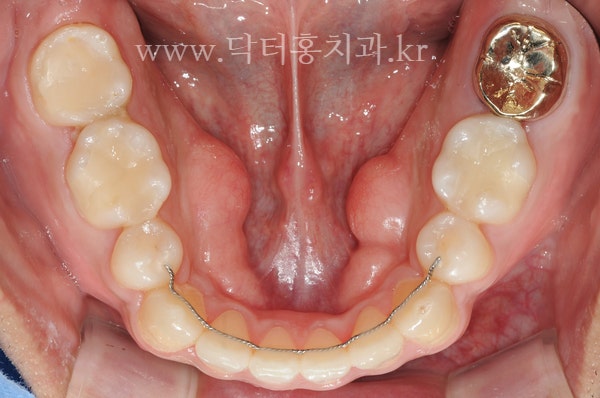 인천 임플란트 치과 임플란트 치료 잇몸뼈 중요성