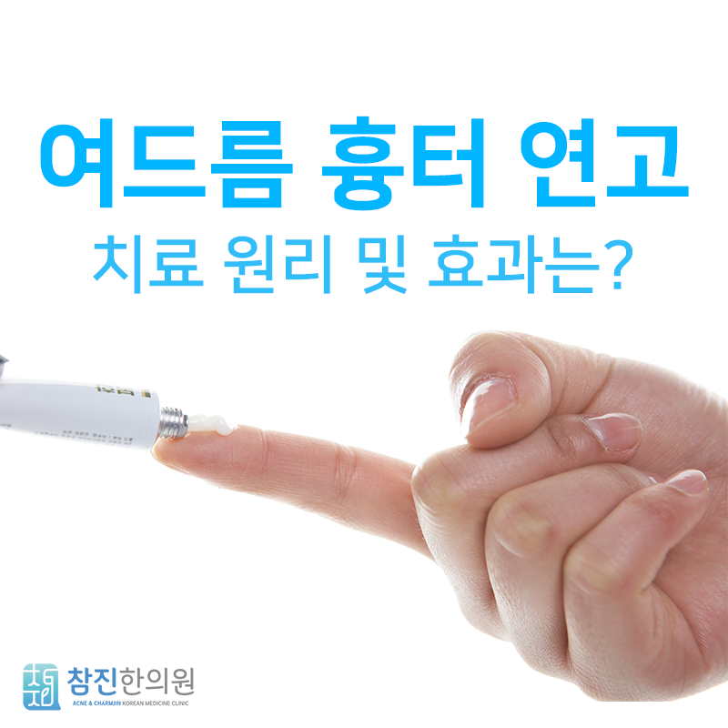 여드름 크림과 여드름 흉터 크림을 따로 사용해야 하는 이유는? 나치 만 있으면됩니다! 12