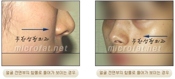 귀족성형을 영구적인 지방이식수술로 5