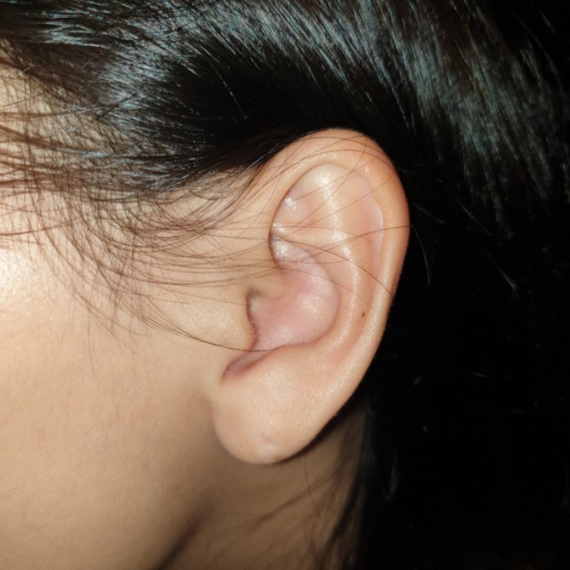귀 안 뾰루지 이절 증상과 치료법✊✊ : 네이버 블로그