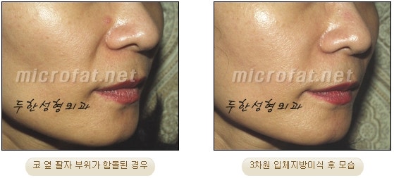 귀족성형을 영구적인 지방이식수술로