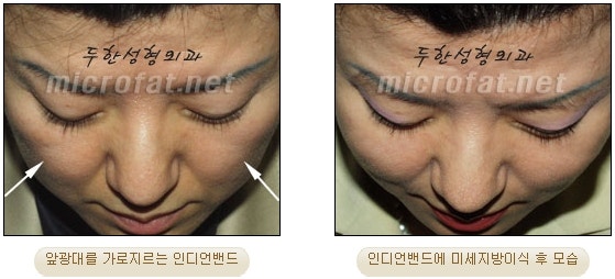 귀족성형을 영구적인 지방이식수술로 2