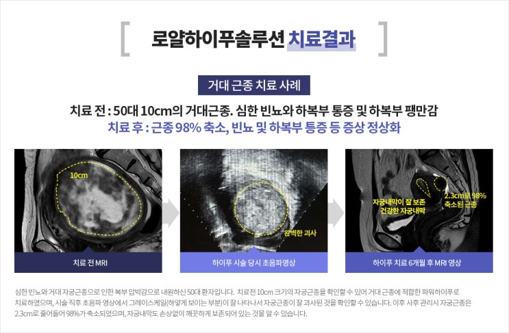  거대자궁근종, 자궁 적출하지 않고 치료가 가능하다?