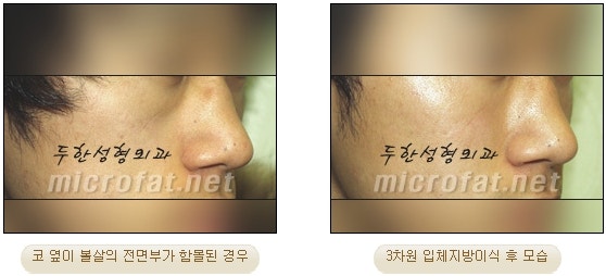 귀족성형을 영구적인 지방이식수술로 4