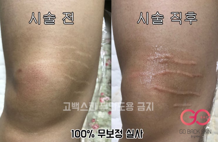  [고백스킨] 튼살타투 다리무릎튼살 살튼자국 튼살 타투 전체시술 및 회복과정 소개