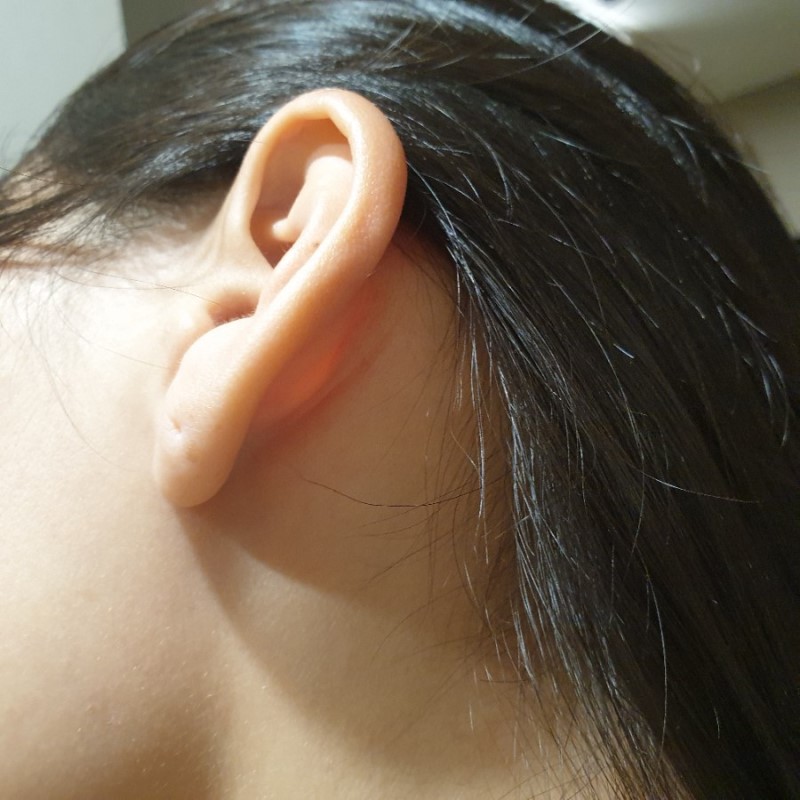 귀 안 뾰루지 이절 증상과 치료법✊✊ : 네이버 블로그