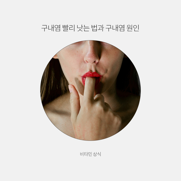  구내염 빨리 낫는 법과 구내염 원인