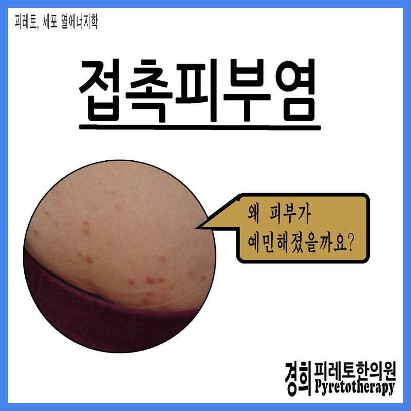 무화과, 석류, 사과, 감알레르기 접촉성 피부 염증상 / 과일 알레르기 검사 및 관리 방법 / 과일당 지수와 당뇨 초기 증상