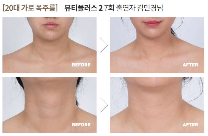 목걸이 하지 왜 목주름 보톡스 했지? 3