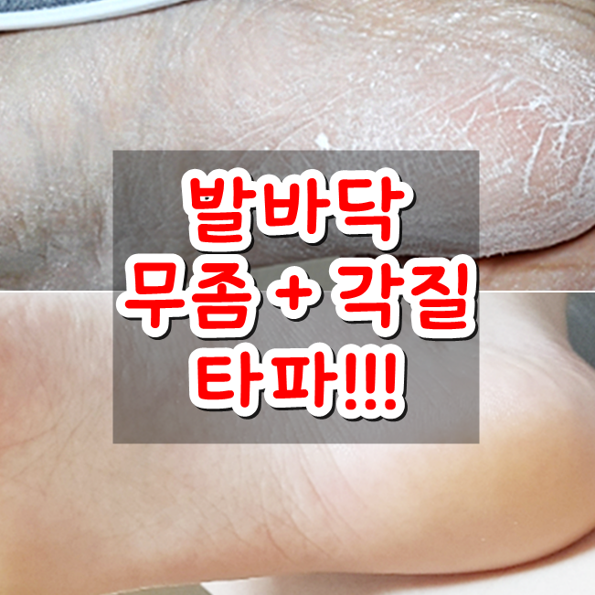  발바닥 무좀 증상 + 발 각질제거 무좀약 끝판왕 (大만족)