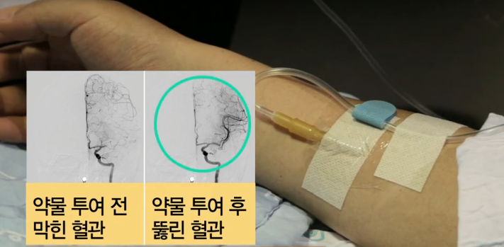 혈전용해제 발견됐어요. 1