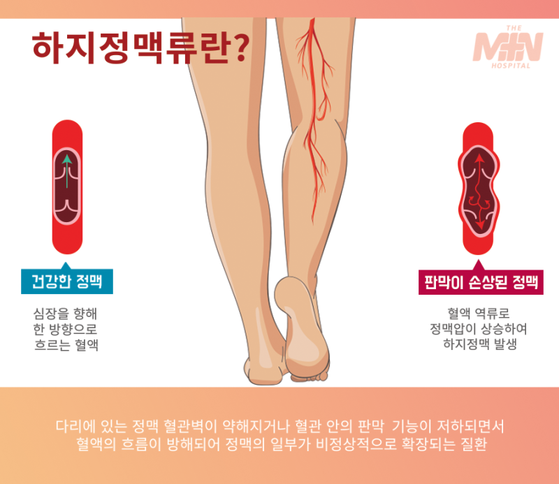 하지정맥류통증 다리 부종 원인 6