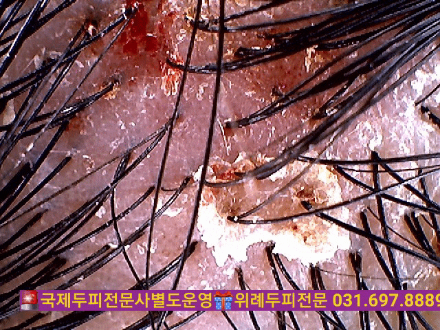  #두피홍반#건조두피가려움#두피염증#두피가려움증#민감성두피#건성두피관리법#위례문제성두피전문관리