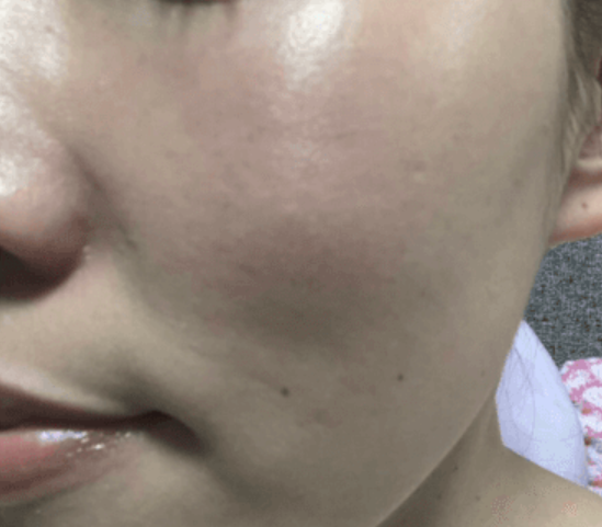  피부가려움증 원인? 얼굴 곰팡이균 [완치후기]