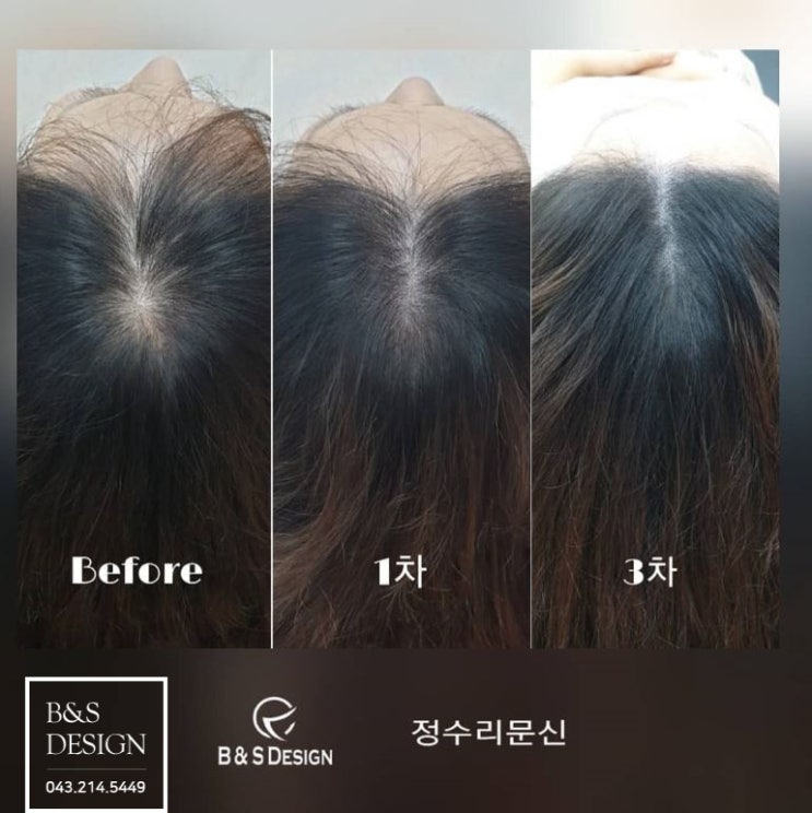  청주정수리문신/장수리타투,정수리흉터커버,SMP두피문신