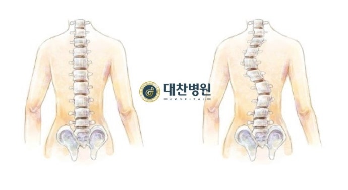 인천척추병원에서 알려주는 청소년 척추측만증 증상