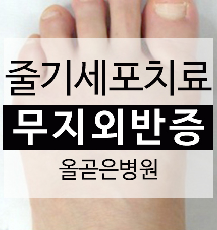  대구 무지외반증 수술 발가락 통증 치료 잘하는 병원/수성구 동구 정형외과/태풍 날씨