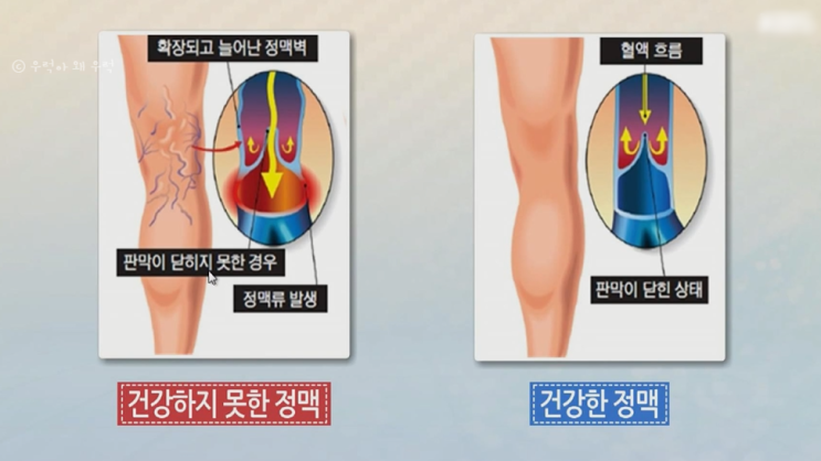  하지정맥류통증 관리, 복합적 혈류기능의 모든 것!