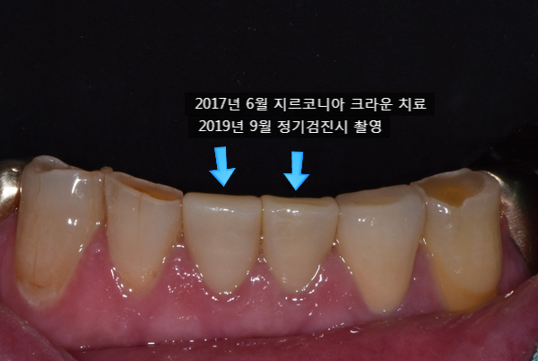  아래 앞니 지르코니아 크라운 2년 3개월 정기검진