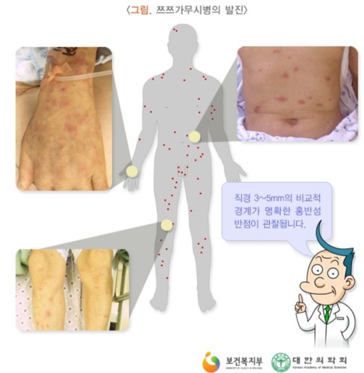  성묘,벌초 갈 때 주의해야할 감염병 및 예방법!(부제 : 쯔쯔가무시, 중증열성혈소판감소증후군,라임병)