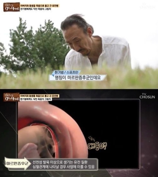  마르판 증후군(Marfan syndrome, MFS)과 장신 한기범 목음체질