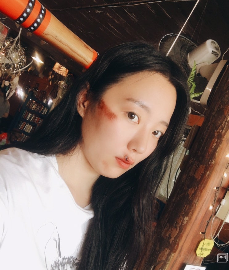  빠이 오토바이 사고 찰과상 낫는 과정