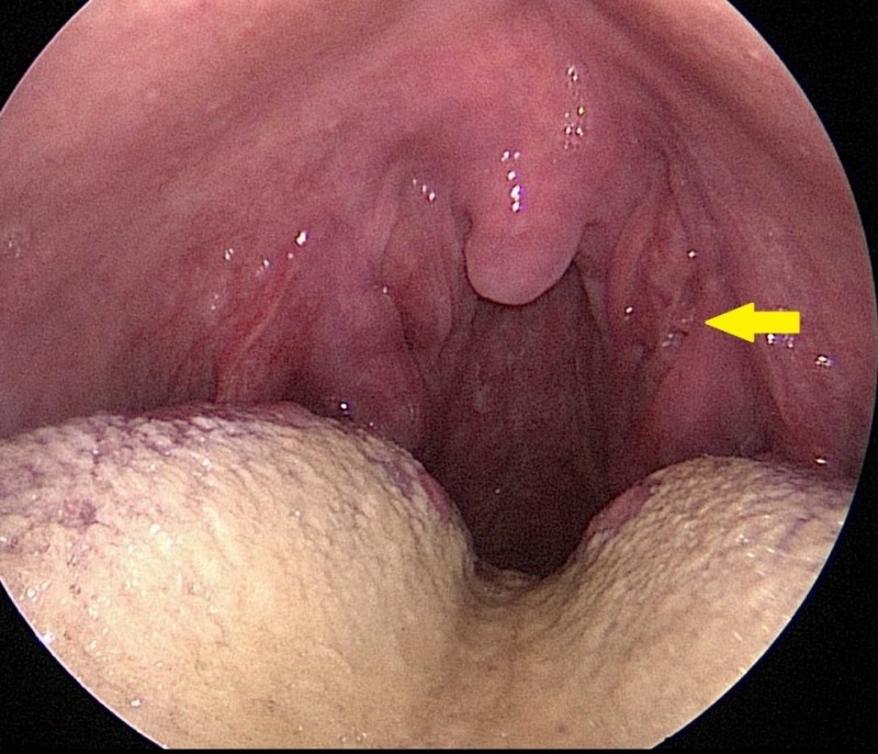 If you suspect early symptoms of tonsil cancer, perform surgery immediately