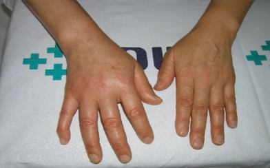 CRPS 국가유공자 및 보훈보상대상자 상이등급