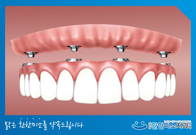 전체치아 임플란트 시작 전 고려사항(과정, 상태, 장단점)