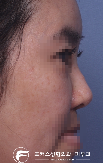  [부천성형외과 Dr. 김 칼럼] 코재수술