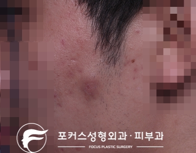  [부천성형외과 Dr. 김 칼럼] 왼쪽 볼의 혹