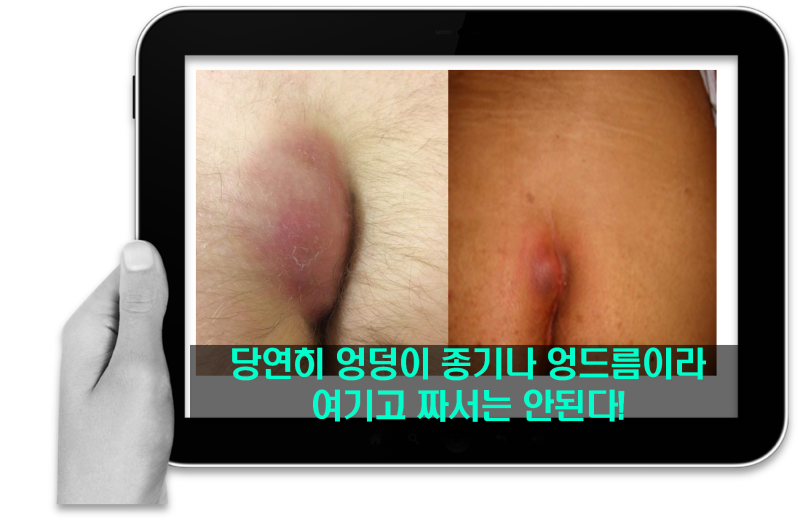 서울항문외과에서 엉덩이에 염증이 생기면 어떻게 해야 하나요?
