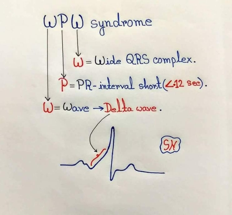  Wpw syndrome