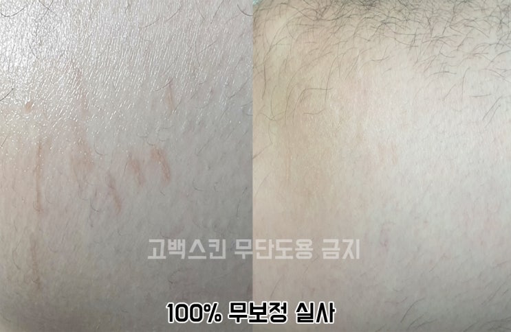  [고백스킨] 튼살타투 운동튼살 남자무릎 살튼자국 튼살 타투 전체시술 및 과정 및 결과동영상 소개