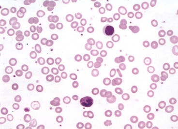 Iron deficiency anemia (IDA, 철결핍성빈혈) : 네이버 블로그